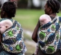 Afrique / Malawi: vague d’attaques brutales contre les albinos