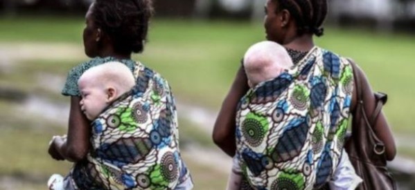 Tanzanie: L’ONU appelle à la protection des albinos